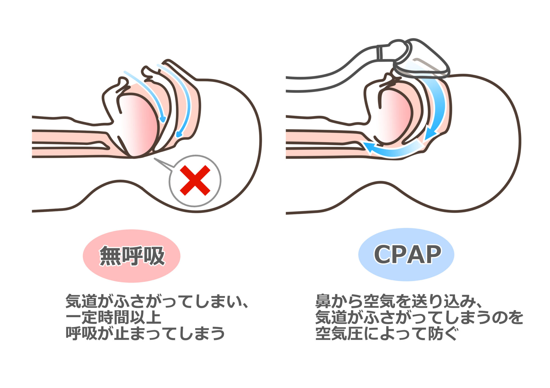 【図】無呼吸では気道がふさがってしまい、一定時間以上呼吸が止まってしまう。CPAP：鼻から空気を送り込み、気道がふさがってしまうのを空気圧によって防ぐ